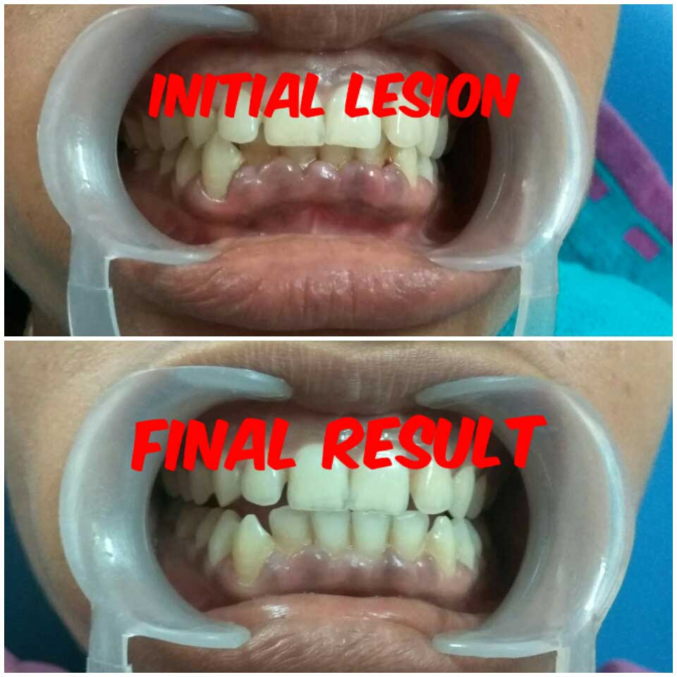 Treatment of Swollen Gums | Maurya Dental Clinic | mauryadentalclinic.in