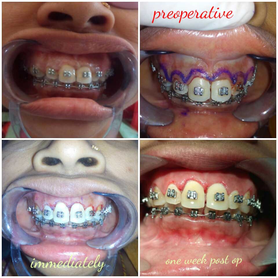 Smile Correction | Maurya Dental Clinic | mauryadentalclinic.in